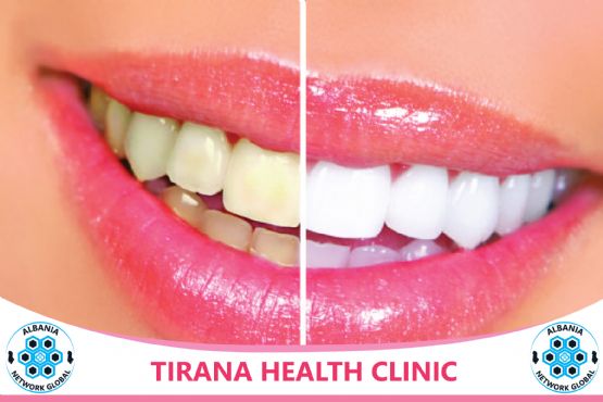 Zbardhim Profesional i Dhëmbeve Nga Dentiste Denisa Kola te TIRANA HEALTH CLINIC